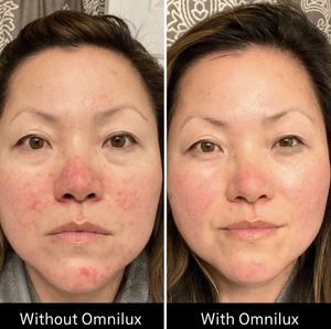 Omnilux Contour LED Mask for Anti-Aging