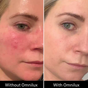 Omnilux Contour LED Mask for Anti-Aging