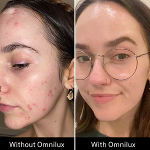 Omnilux Clear LED Mask