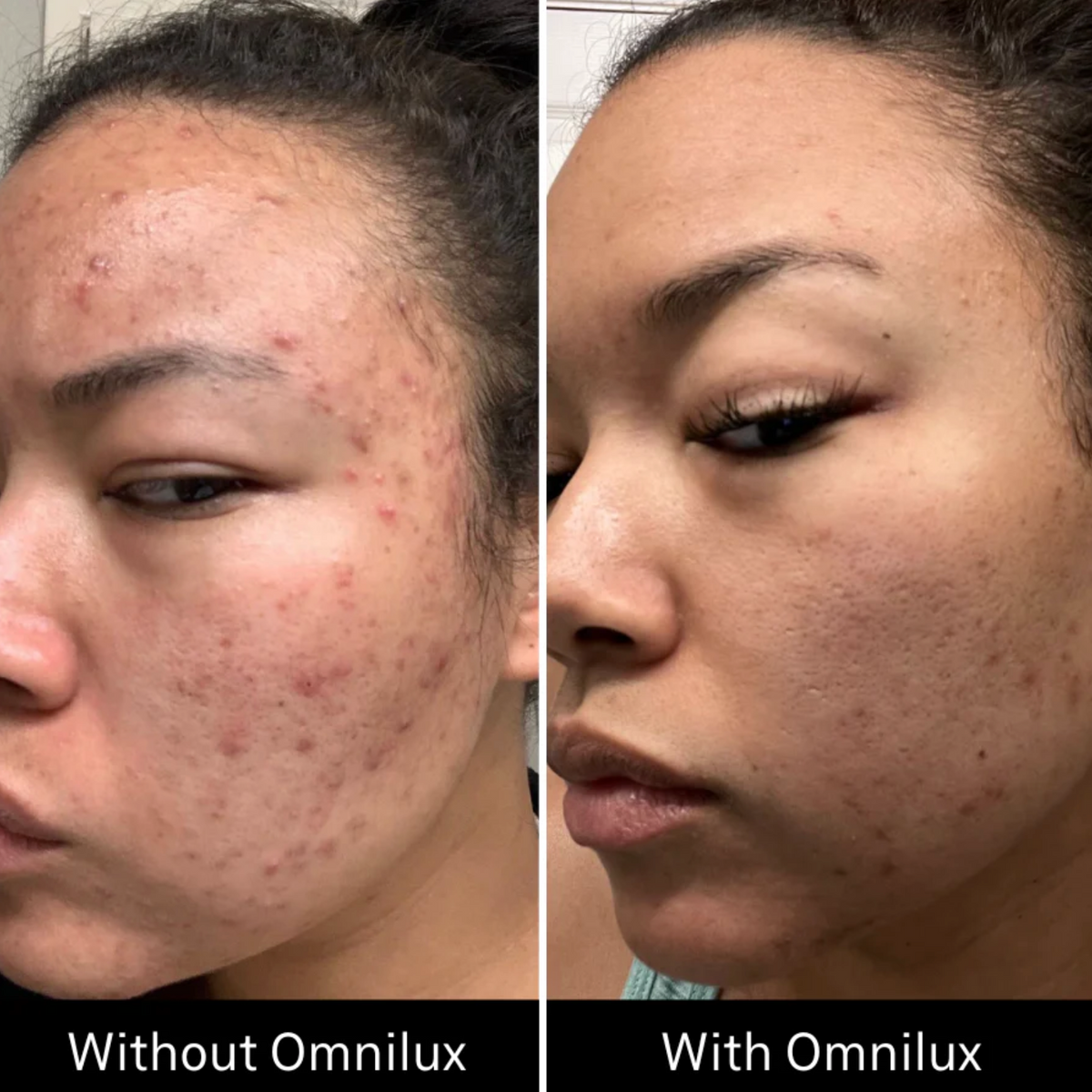 Omnilux Clear LED Mask